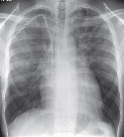 肺水肿病人如何给氧?肺水肿的给氧