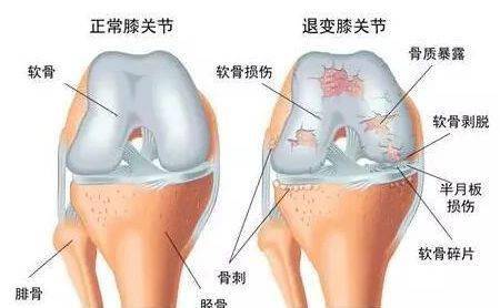 膝盖退行性变如何锻炼?女性膝关节退行性多大年龄正常