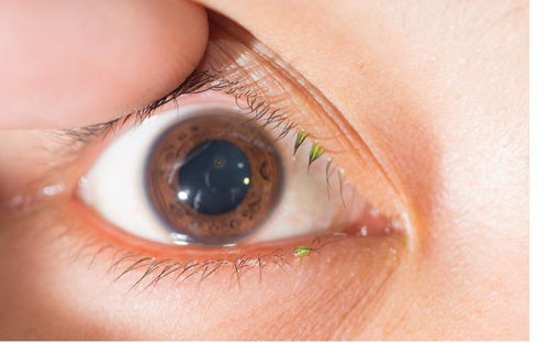 如何治疗眼部黄素瘤?如何治疗眼部黄素瘤病