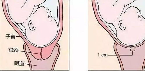 如何加快宫颈管展平?怎么能促进宫颈管成熟