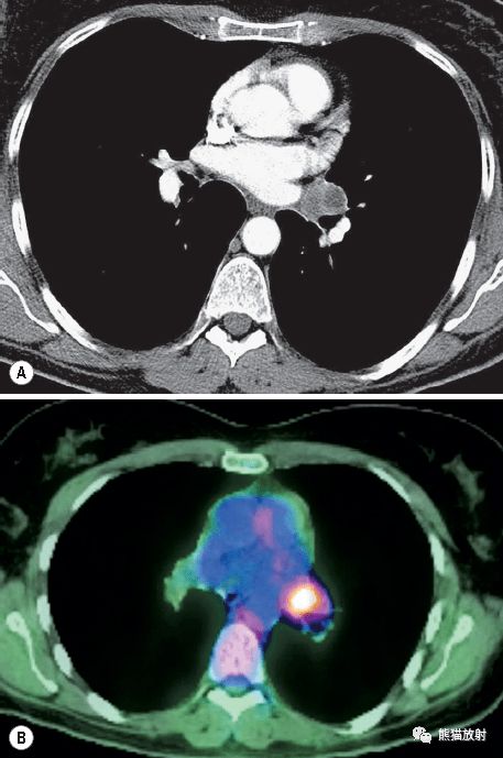 如何防止小细胞肺癌复发?如何控制小细胞肺癌扩散