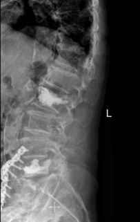 腰椎胝骨第五节断裂应如何保养?腰椎第五节骨质破坏怎么回事