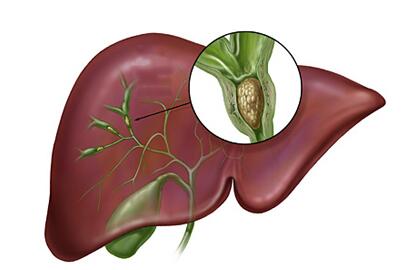 胆囊癌如何知道肝转移?胆囊癌肝转移的症状