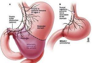 肝分泌的胆汁如何排入十二指肠?胆汁由肝门排出经哪些途径排入十二指肠