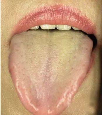 舌苔发白是怎么回事？（舌苔厚白）